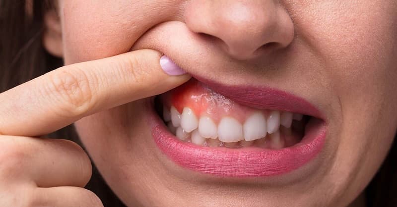 lưu ý ngưng dùng miếng dán trắng răng khi viêm nướu, lợi